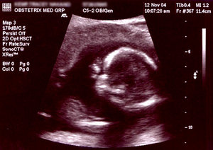 Ultrasound 16 weeks